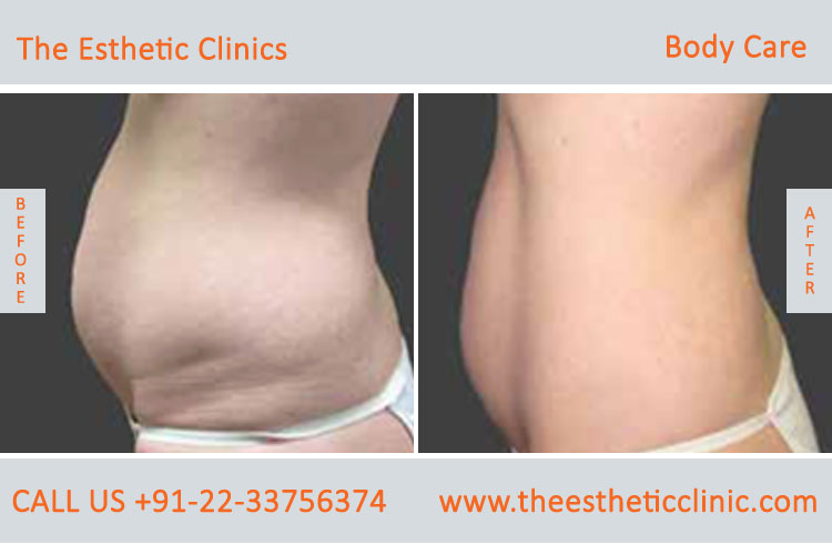 body care laser treatment before after photos in mumbai india (3)